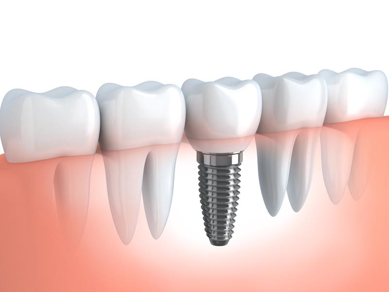 Dental Implants Atlanta, GA 